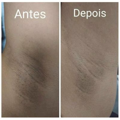 Kit Poderoso Contra Manchas Nas Axilas Micosan 2 Sabonete 2  Sabonete Argila Branca