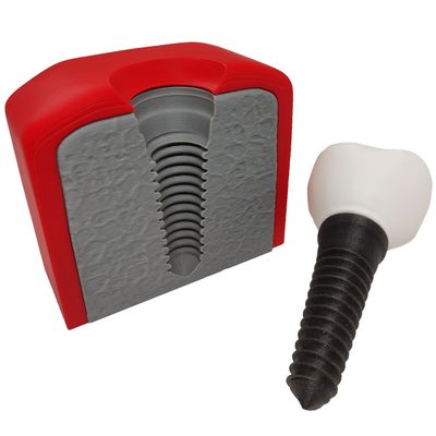 Implante Dental Análise Modelo Dentário Dente 3D Anatomia