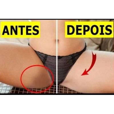 Kit 6 Pomadas Micosan 3 Meses de Uso Diário Contra Manchas